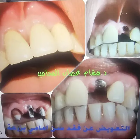Supplied collage documenting stages of an anterior tooth implant restoration, as labelled in the image.