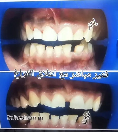 Before-and-after comparison for direct veneers and gap closure, as labelled in the supplied image.
