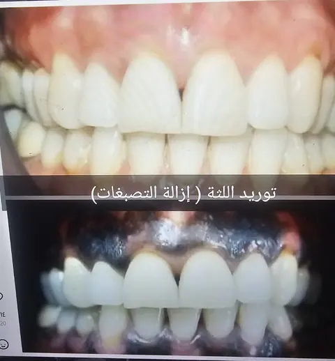 Supplied comparison labelled gingival depigmentation in the original collage.