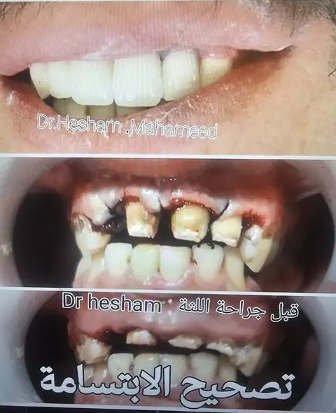 مراحل حالة تتضمن جراحة اللثة وتصحيح الابتسامة بحسب النص الأصلي؛ الصورة تتضمن تفاصيل سريرية جراحية.