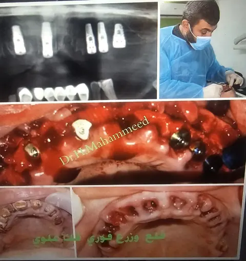 مجموعة صور وأشعة من عمل زراعة الأسنان؛ تتضمن مشاهد جراحية وتوثيقًا لعدة مراحل.