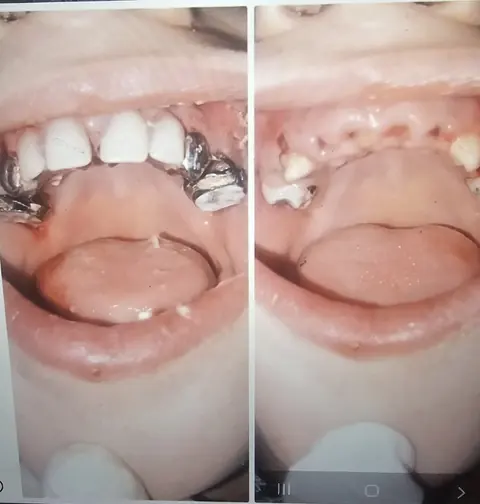 صورتان داخل الفم لتوثيق حالة أسنان مفقودة؛ لا يحدد الملف توقيت كل صورة أو تفاصيل الخطة العلاجية.