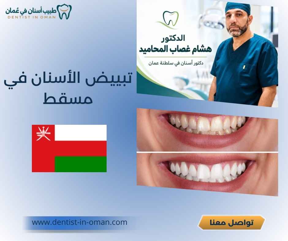تبييض الأسنان في مسقط تبييض الأسنان في مسقط